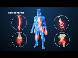 Nutrients for Rapid Relief of Joint Pain